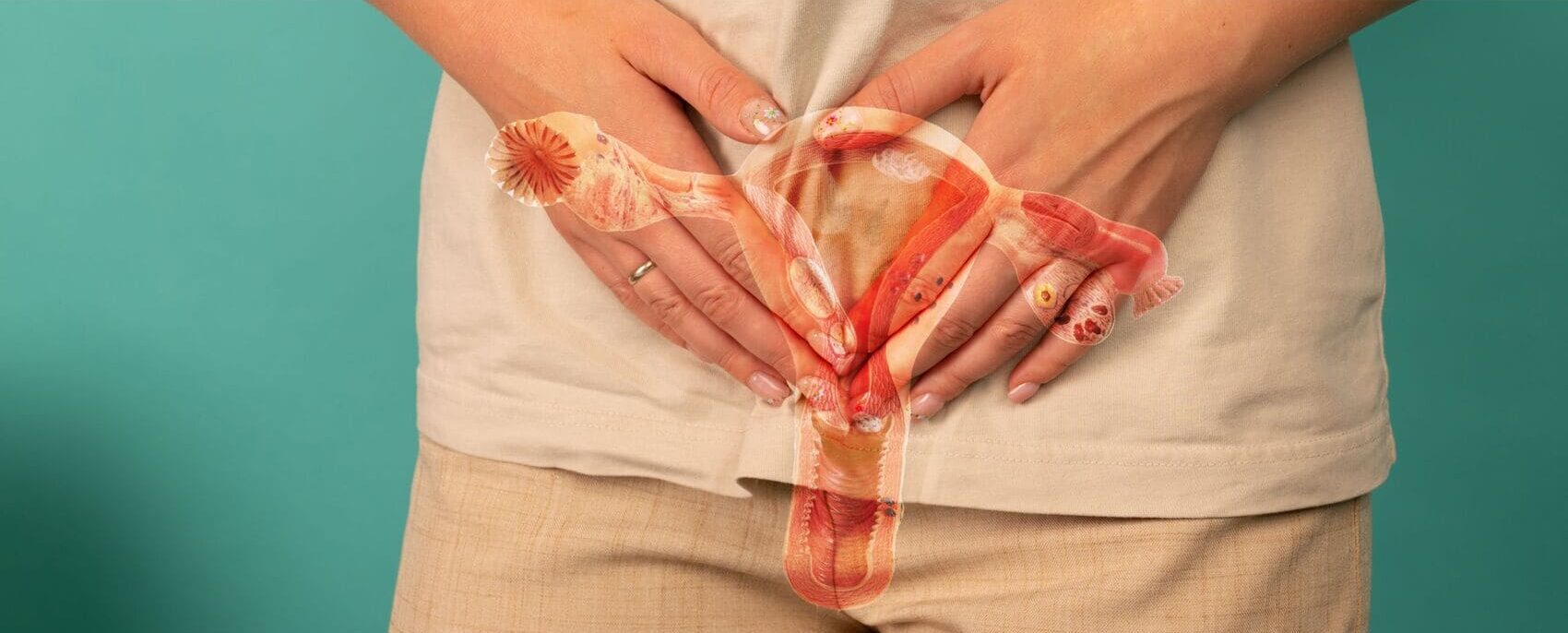 Endometriosis: Señales ‘Silenciosas’ Que Muchas Mujeres Normalizan