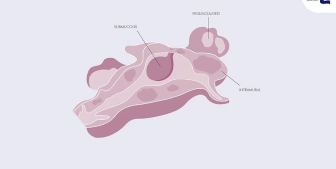 Pelvic adhesions