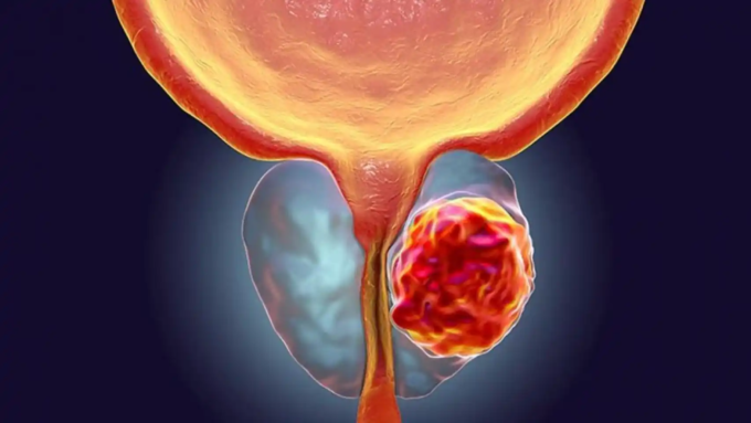Vista de células prostáticas al microscopio