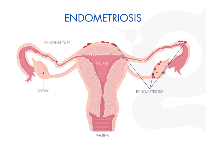 Endometriosis illustration