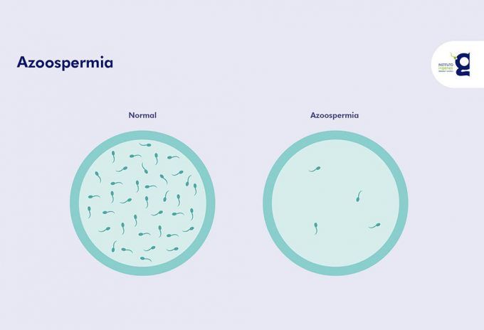 imagen de azoospermia obstructiva vs no obstructiva