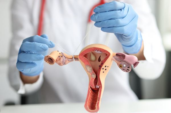 Ilustración de endometriosis