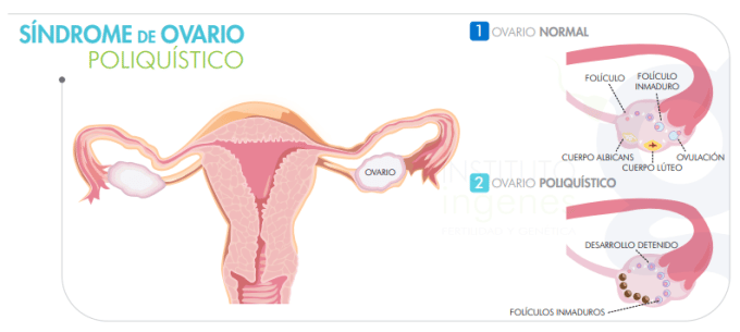 sindróme-de-ovario-poliquístico-según-la-edad-de-la-mujer-imagen-de-ovarios-con-problema-de-sop-ovario-poliquístico
