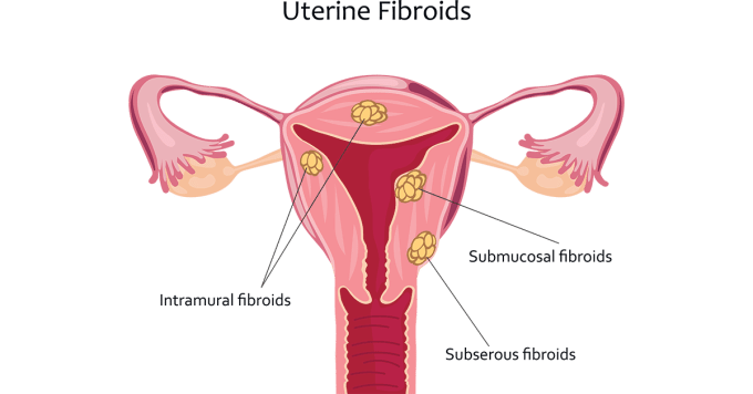 infographic types of fibroids by location