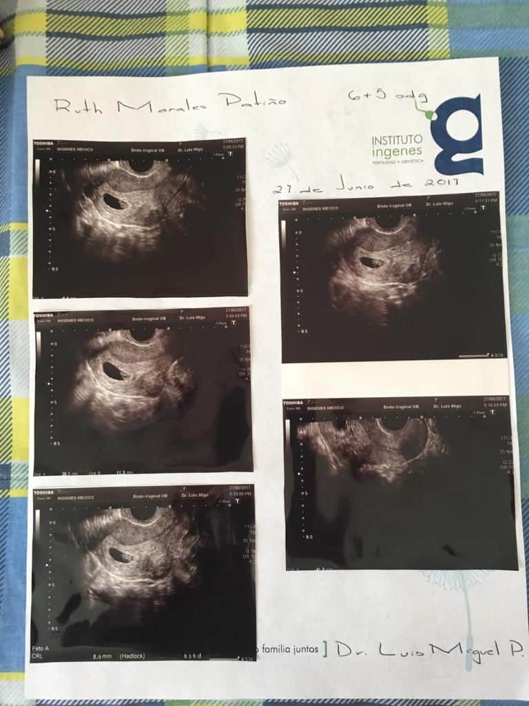 Ultrasound during IVF