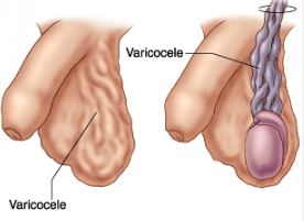 Varicocele e infertilidad