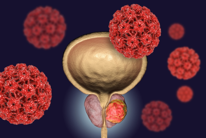 Opciones de tratamiento para cáncer de próstata