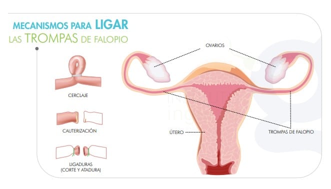 mecanismos para ligar las trompas de falopio