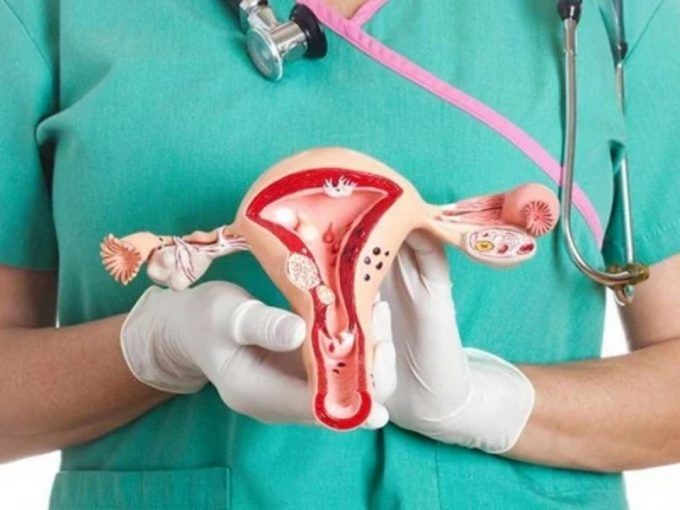 polycystic ovary