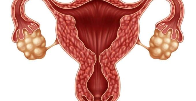 Illustration of ovaries with PCOS