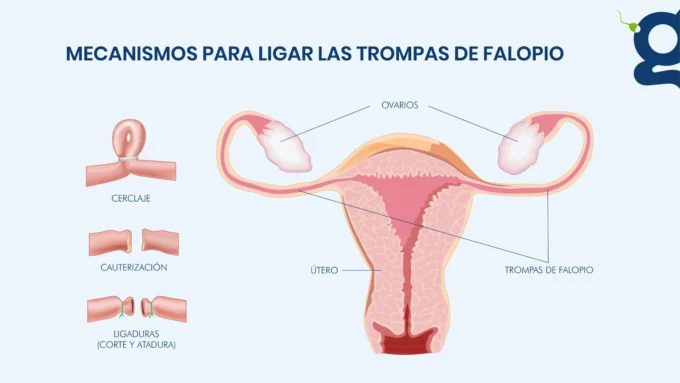 Ligadura de trompas