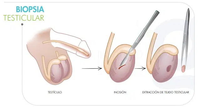 procedimiento-biopsia-testicular