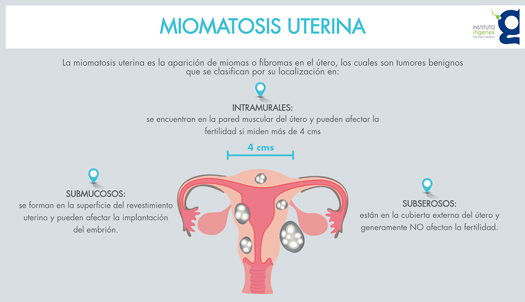 Que Es La Miomatosis Uterina Y Cuales Son Sus Modafinil24