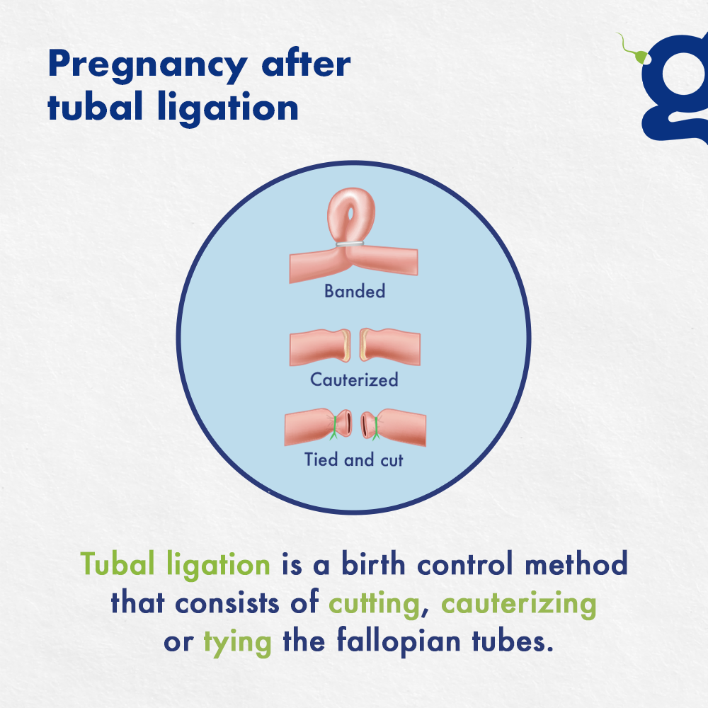 Is It Normal To Regret Tubal Ligation? What Are Your Options?